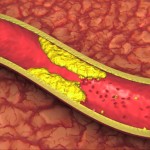 These 9 Things May Cause Atherosclerosis