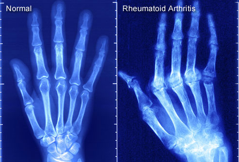 image rheumatoid_arthritis