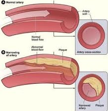 What You Should Know About Atherosclerosis