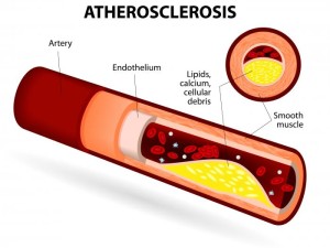 3 Important Treatments for Atherosclerosis