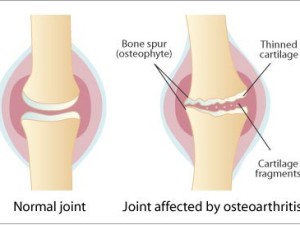 How to Treat Osteoarthritis