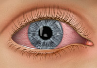 How to Prevent Pink Eye (Conjunctivitis)