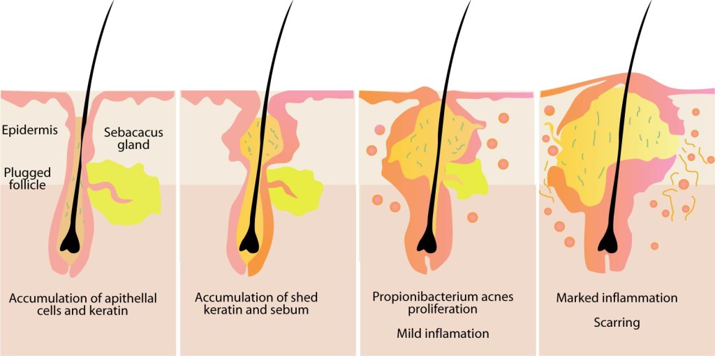 causes of Acne 2